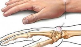 手腕腱鞘炎按摩视频,专业按摩视频教程解析