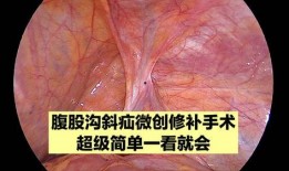 腹股沟疝手术视频,腹股沟疝手术操作步骤详解