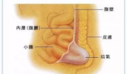腹股沟疝手术视频,腹股沟疝手术操作步骤详解