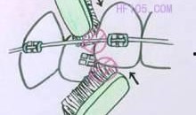 上环的过程视频,直观演示与注意事项