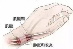 手腕腱鞘炎按摩视频,专业按摩视频教程解析