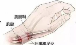 手腕腱鞘炎按摩视频,专业按摩视频教程解析