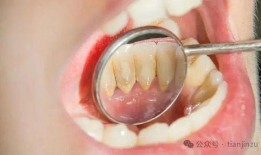 去牙结石视频全过程,专业操作与效果展示