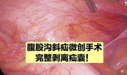 腹股沟疝手术视频,腹股沟疝手术操作步骤详解